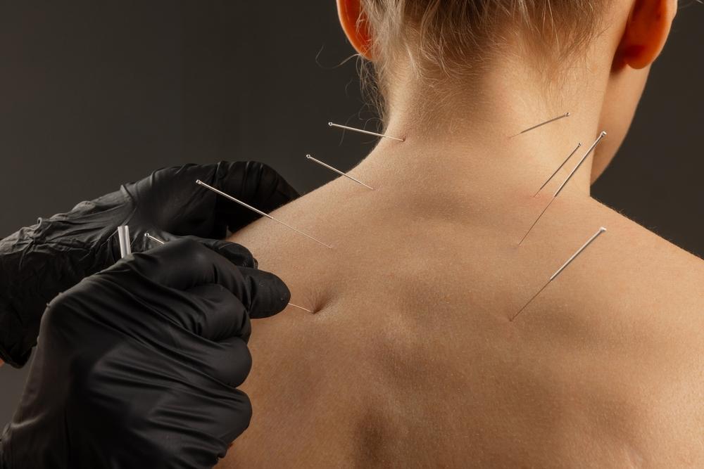 Acupuncture Pain Management